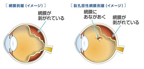 網膜剥離の原因