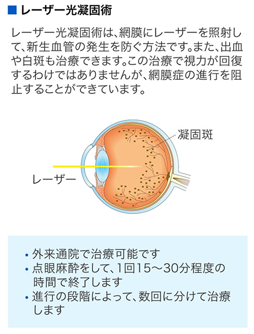 レーザーによる光凝固術